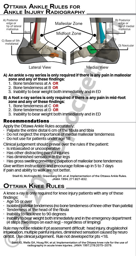 Ortho_-_Ottawa_Ankle_Rules