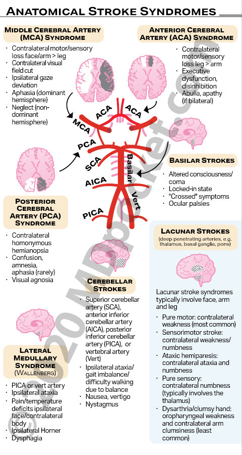 Stroke_SNF