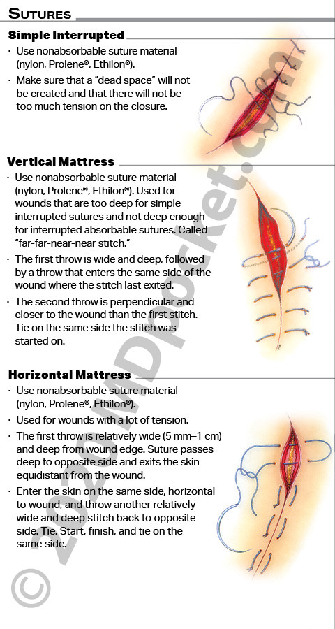 Sutures
